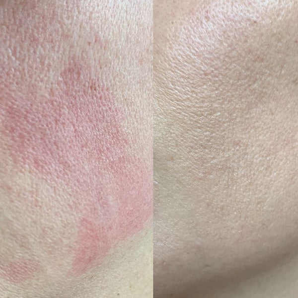 How Can You Tell If Your Skin Is Sensitive, Sensitised, or Reactive?