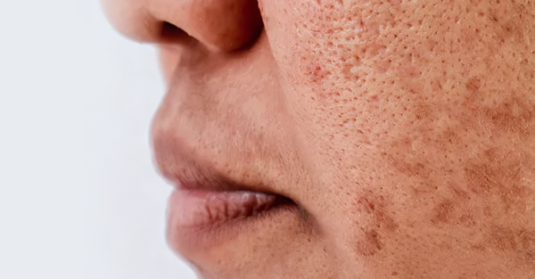 The Rising Concern of Anti-Aging: Why More People Are Worried About Aging Skin